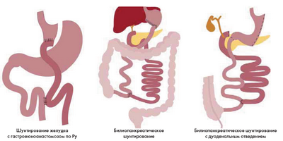 Модифицированная бариатрическая хирургия обеспечивает ремиссию диабета 2 типа