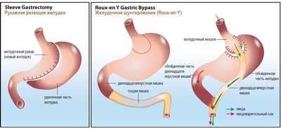Исследование обнаружило изменение в типе процедуры, наиболее часто используемой при бариатрической хирургии