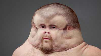 Эксперты эндокринологического общества изучают, как диабет вредит мельчайшим кровеносным сосудам организма