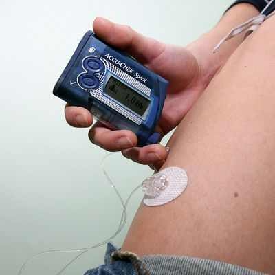 Искусственная поджелудочная железа - безопасное и эффективное лечение диабета 1 типа