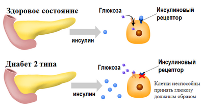 Неправильное производство молекулы инсулина может привести к диабету
