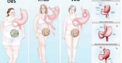 Одна операция по снижению веса дает стойкие результаты