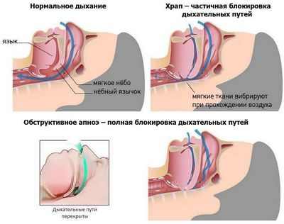 Апноэ во сне связано с бесшумными инсультами, небольшими поражениями в головном мозге