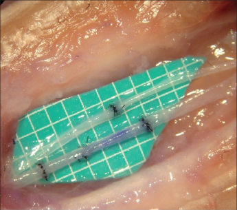 Бариатрическая хирургия связана со значительным сокращением микрососудистых осложнений диабета 2 типа Бариатрическая хирургия связана со значительным сокращением микрососудистых осложнений диабета 2 типа